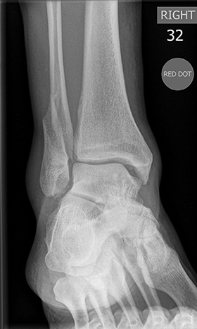 Ankle Fractures