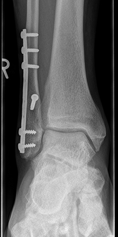 Ankle Fractures