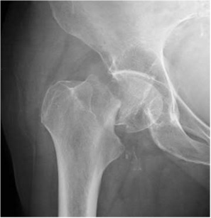 Hip Fracture