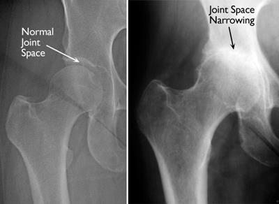 Total Hip Replacement