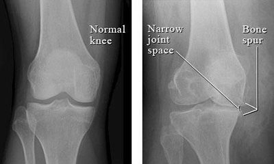 Total Knee Replacement