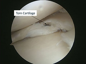 Partial Meniscectomy