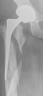 Periprosthetic Hip Fractures