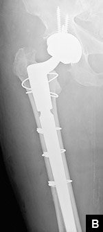 Periprosthetic Hip Fractures