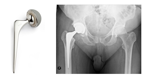 Total Hip Replacement