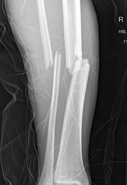 Tibial Fractures