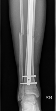 Tibial Fractures