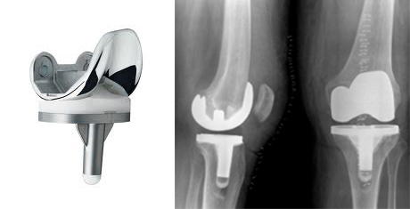 Total Knee Replacement